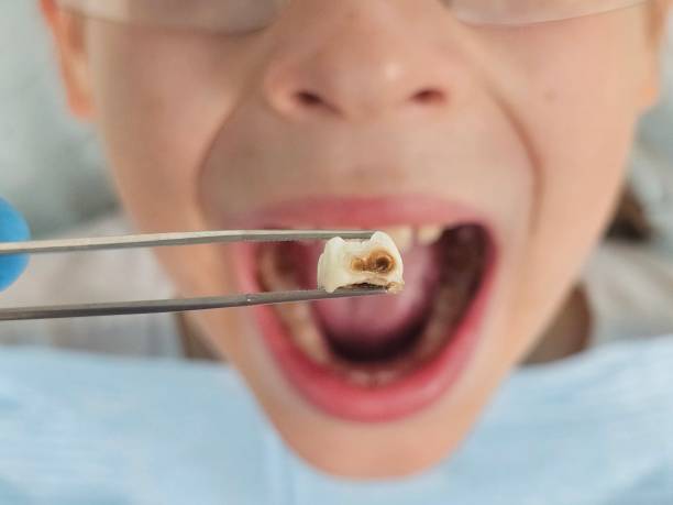 Best Emergency Root Canal Treatment in Monticello, MN